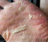 掌蹠膿疱症の写真